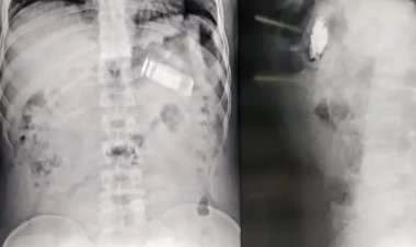 जयपुर सेंट्रल जेल में बंद एक कैदी ने प्रहरी को देखकर मोबाइल निगल लिया  